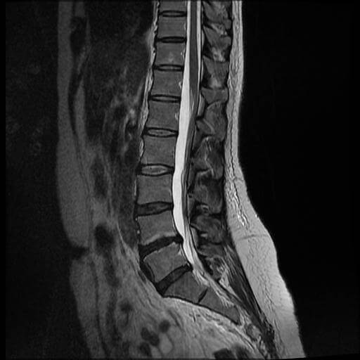 腰部MRI画像