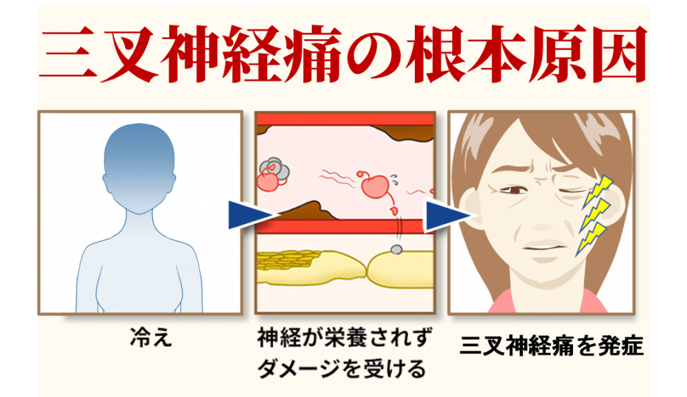 三叉神経痛の根本原因