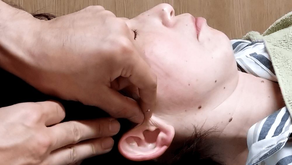 突発性難聴に対する末梢神経再生施術