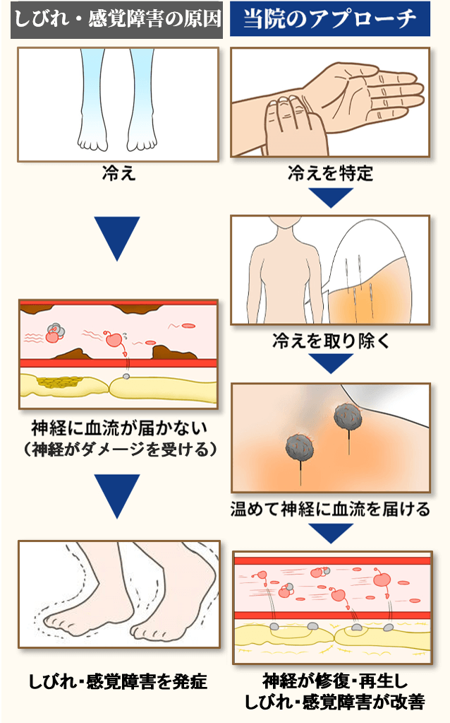 足根管症候群 奈良県橿原の鍼灸院 しびれ 麻痺専門 三つ柱治療院