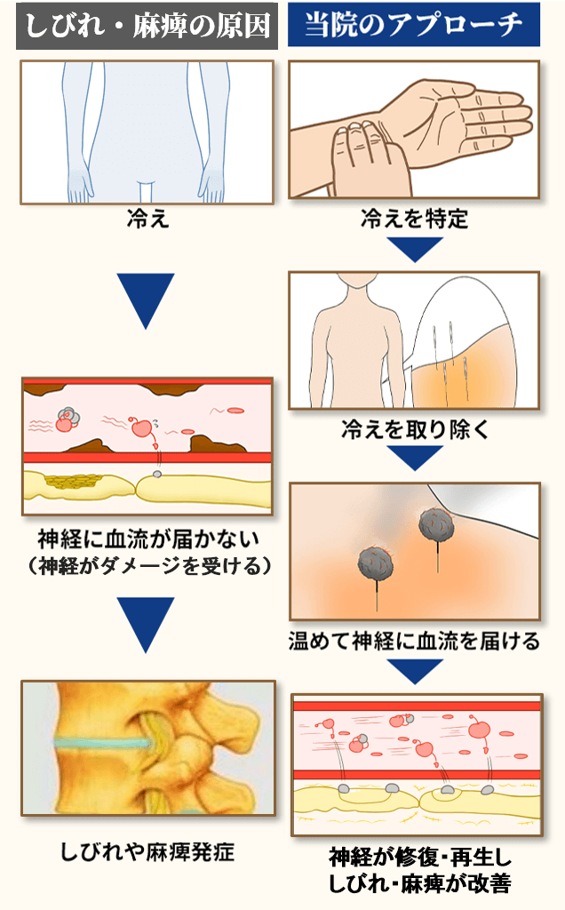 椎間板ヘルニアの原因とアプローチ