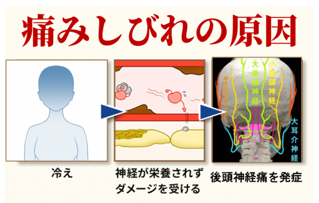 後頭神経痛 奈良県橿原の鍼灸院 しびれ 麻痺専門 三つ柱治療院