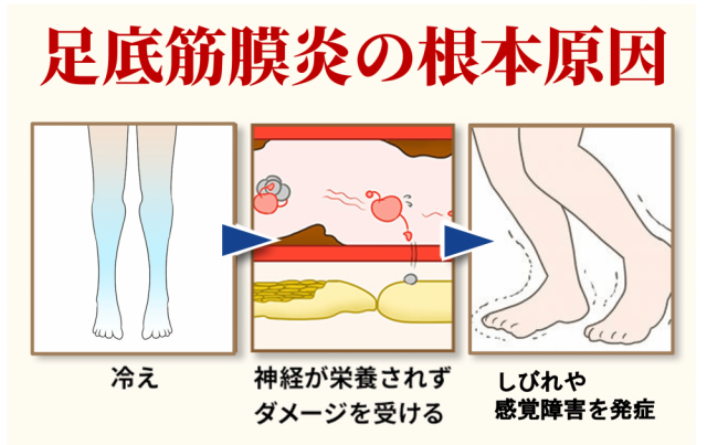 足底筋膜炎の根本原因