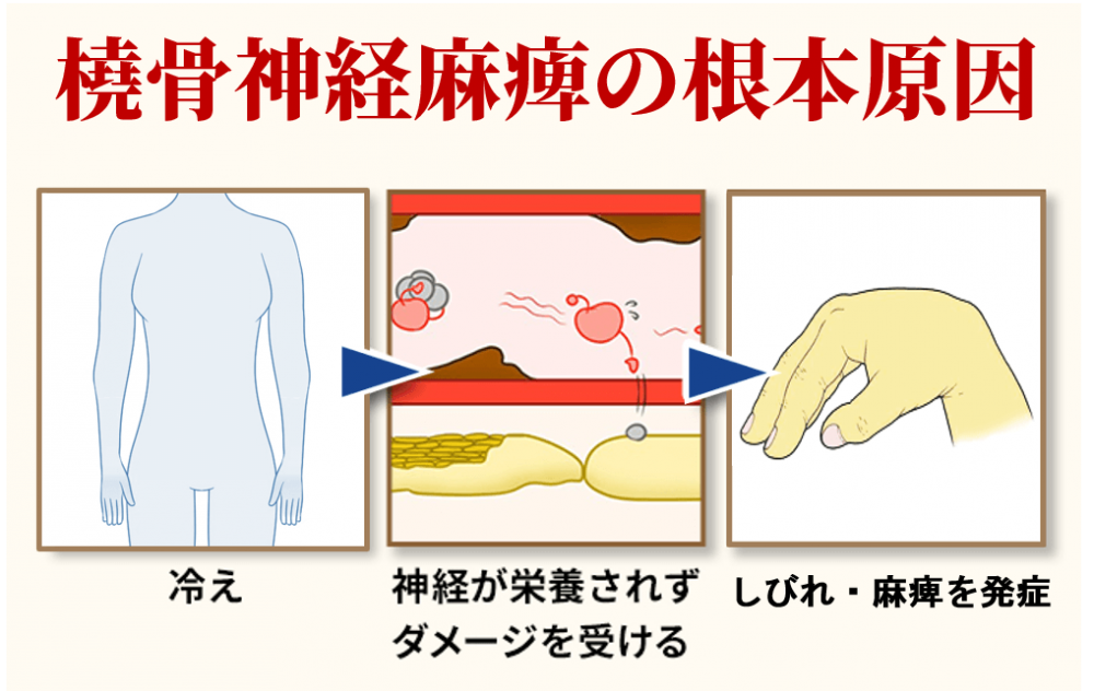 橈骨神経麻痺の根本原因