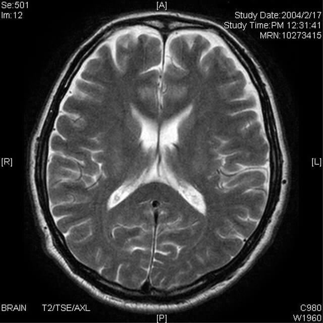 脳のMRI画像