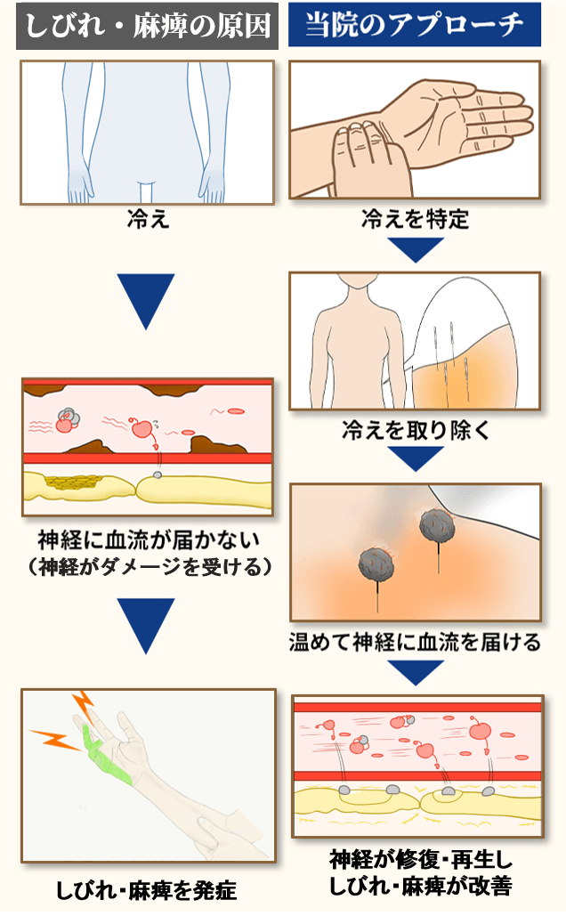 肘部管症候群の原因とアプローチ