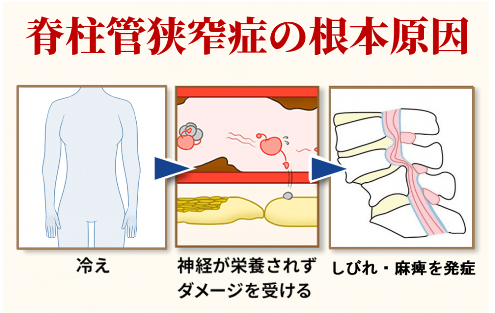 脊柱管狭窄症の根本原因