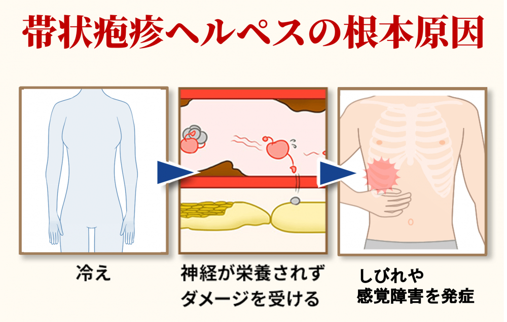 帯状疱疹ヘルペスの根本原因