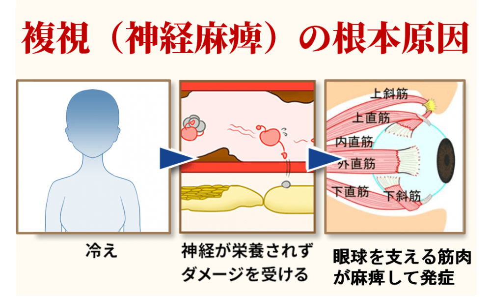 複視の根本原因