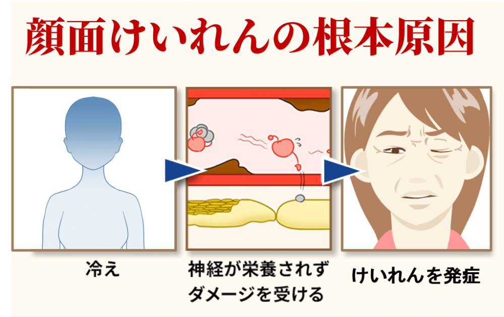 顔面けいれんの根本原因