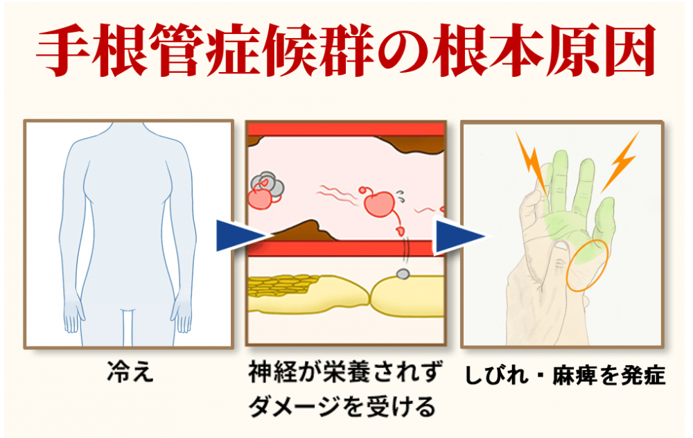 手根管症候群の根本原因