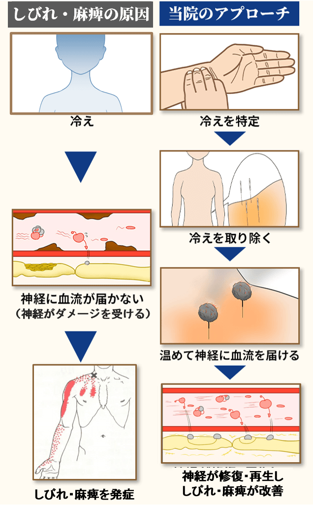 胸郭出口症候群 奈良県橿原の鍼灸院 しびれ 麻痺専門 三つ柱治療院