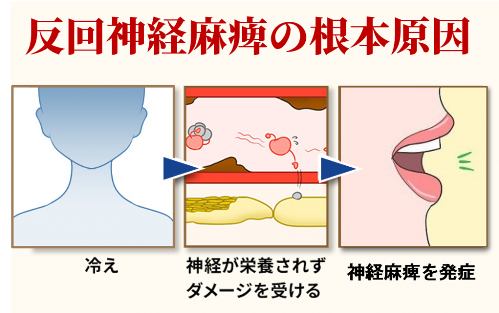 反回神経麻痺の根本原因