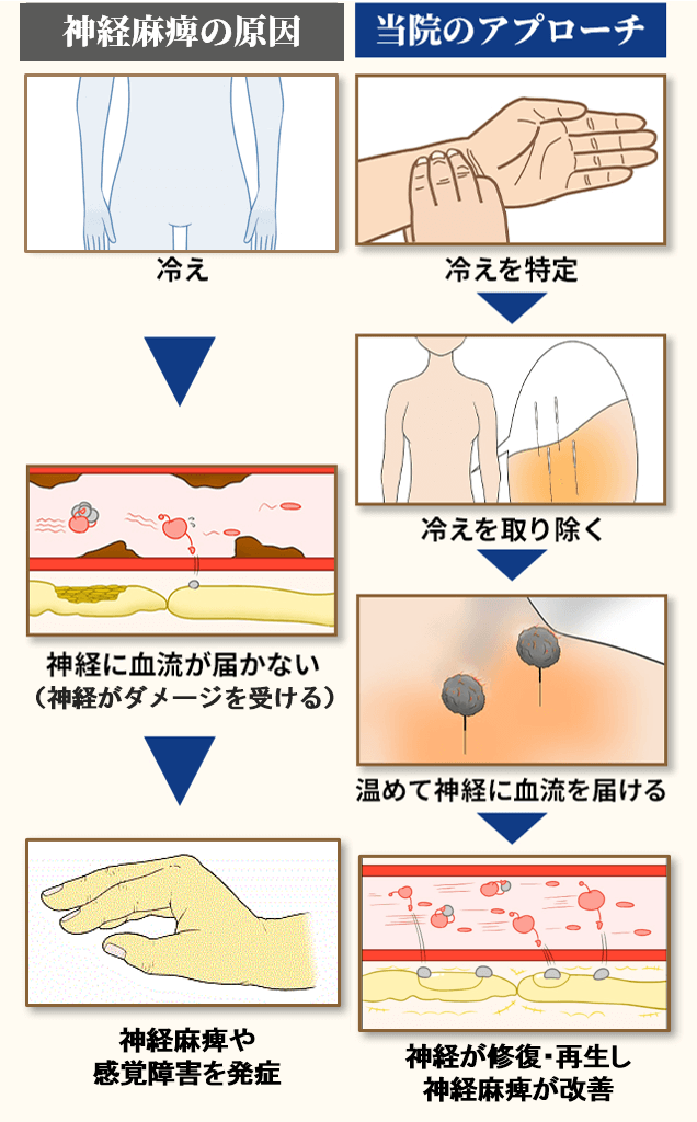 骨間神経麻痺の原因とアプローチ
