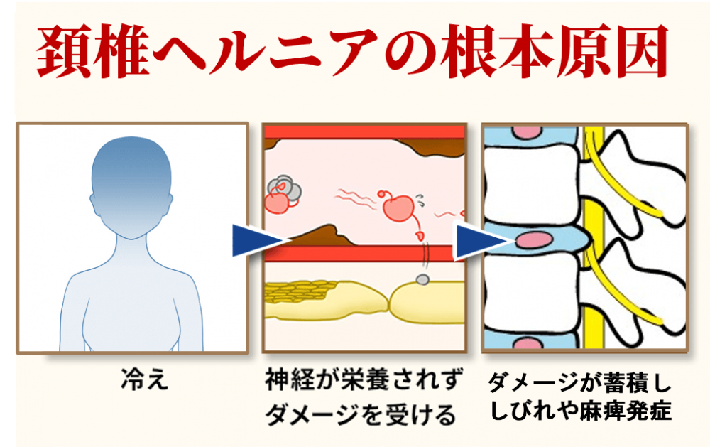 頚椎ヘルニアの根本原因