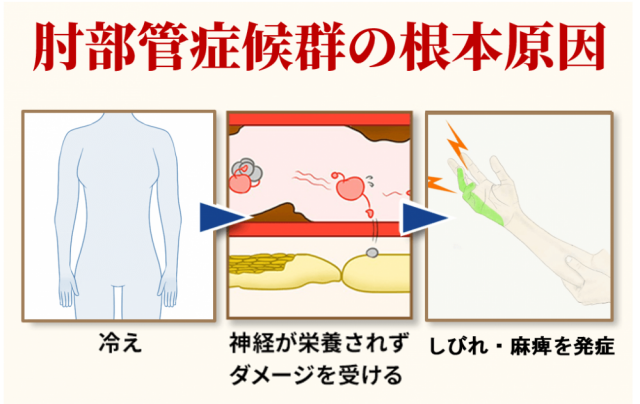 肘部管症候群の根本原因