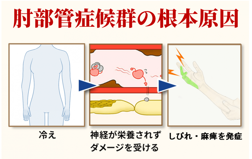 肘部管症候群の根本原因