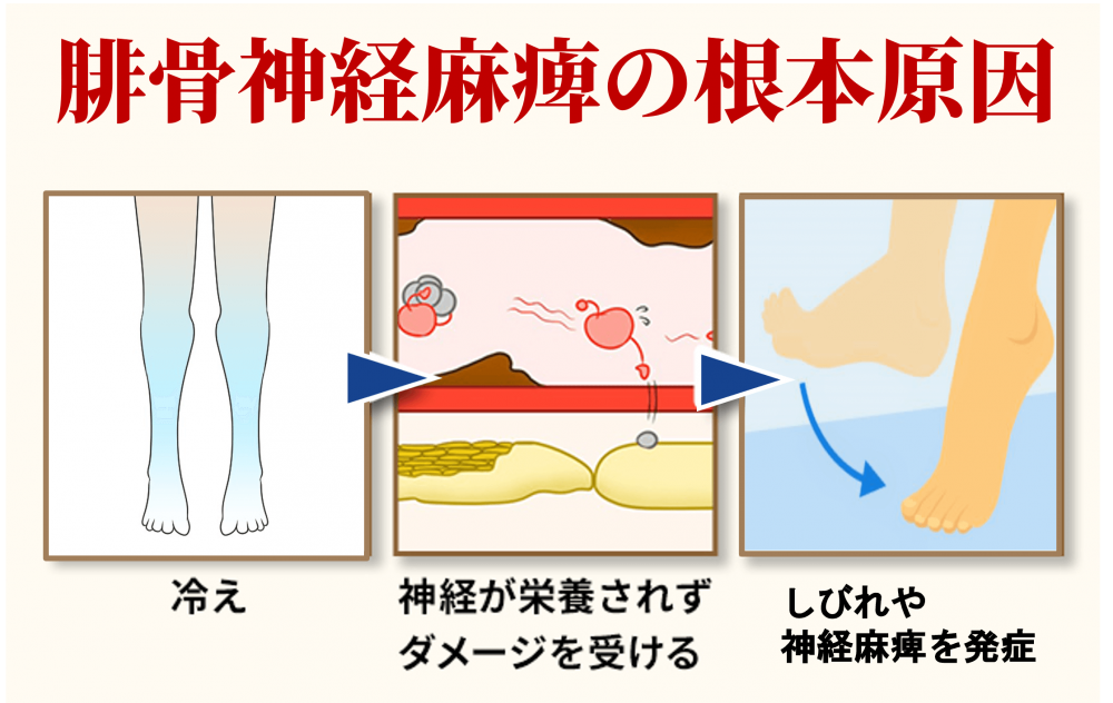 腓骨神経麻痺の根本原因