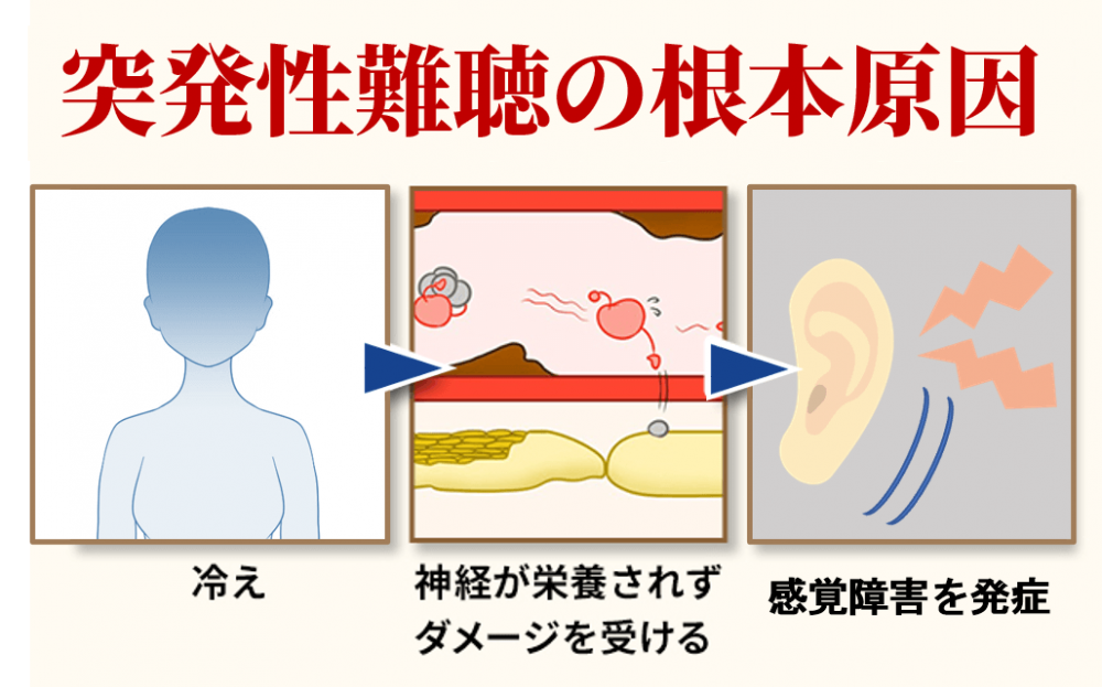 突発性難聴の根本原因