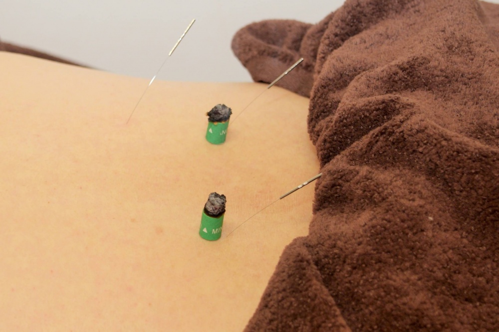 独自のはりきゅう施術