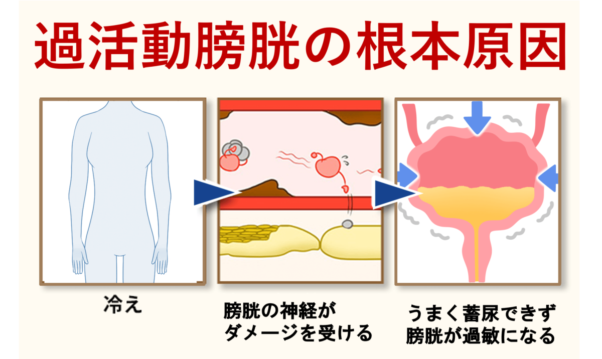 過活動膀胱の根本原因
